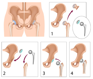 17 To-Do Items Before Hip Replacement Surgery