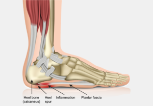 EPAT: Alternative Treatment Surgery for Plantar Fasciitis