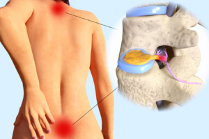 What You Should Know About a Herniated Disc on Your Sciatic Nerve - The  Nerve & Disc Institute