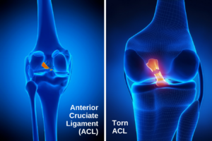 Anterior Cruciate Ligament (ACL) & Medial Collateral Knee Ligament (MCL)  Injuries