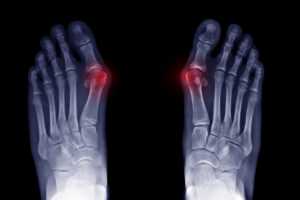 Learn More About Bunions