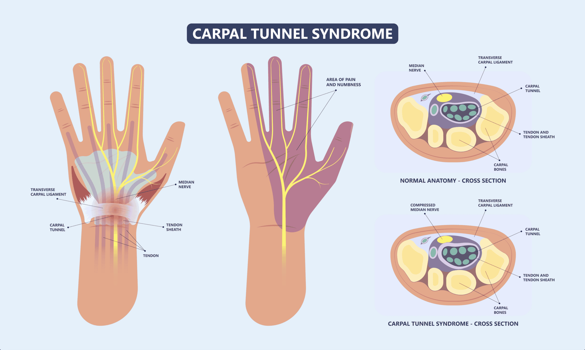 Can Carpal Tunnel Syndrome Cause Upper Arm Pain Detroit Chinatown