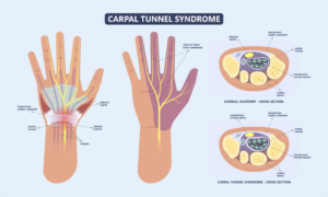 Carpal Tunnel Decompression Symptoms, Diagnosis, and Treatments