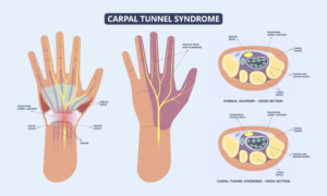 Carpal Tunnel Relief, Wrist Pain, Diagnosis & Treatment