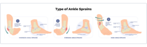 Types of Ankle Sprains, Symptoms and Treatments: Phoenician Foot
