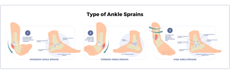 Ankle Sprains: Different Types & Grades