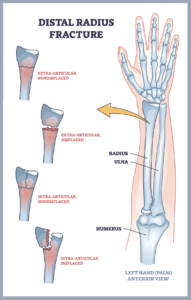 Saml op Fighter fordøjelse Wrist Sprain vs. Wrist Fracture | Advanced Ortho and Spine