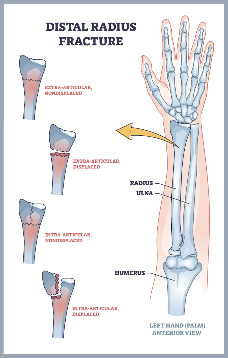 Wrist Sprain vs. Wrist Fracture Advanced Ortho and Spine