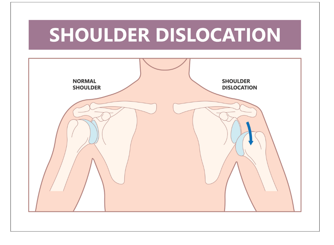 Separated Shoulder vs. Dislocated Shoulder AOS