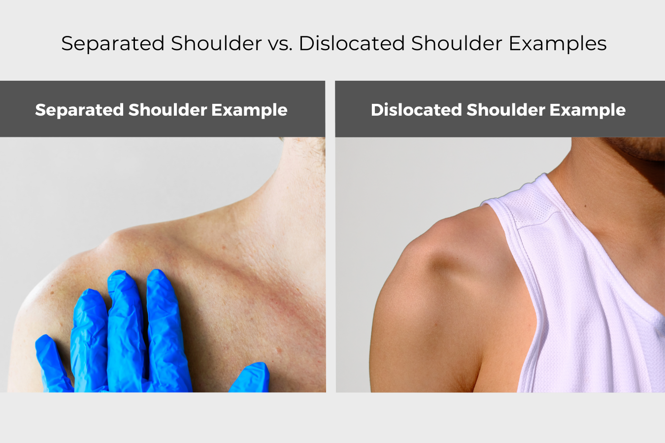 Separated Shoulder vs. Dislocated Shoulder AOS