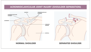 Acromioclavicular (AC) Joint Dislocation / Separation