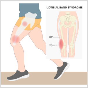 Knee Pain Could Indicate IT Band Syndrome