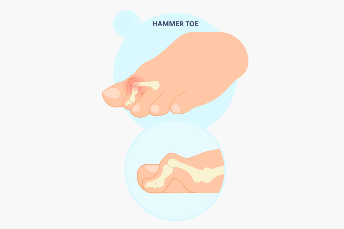Hammertoe & Mallet Toe A Comprehensive Guide AOS