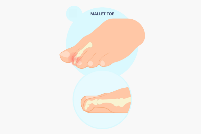 Hammertoe & Mallet Toe A Comprehensive Guide AOS